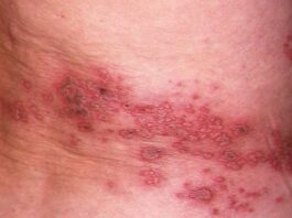 POTRET: Bintil berisi air timbul di sisi kanan tubuh penderita herpes zoster cacar api (cacar ular) yang disebabkan oleh virus varicella-zoster. (Dok. Istimewa)