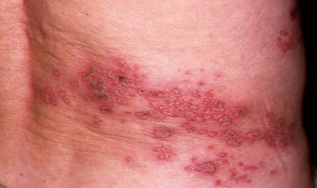 Cacar Api Bisa Serang Segala Usia, Yuk Kenali Penyebab hingga Gejalanya POTRET: Bintil berisi air timbul di sisi kanan tubuh penderita herpes zoster cacar api (cacar ular) yang disebabkan oleh virus varicella-zoster. (Dok. Istimewa)
